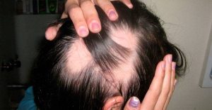 Selección de sintomas de caida de pelo para comprar en Internet – Los preferidos